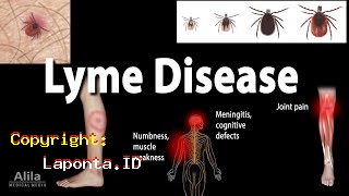 Penyakit Lyme Terbaru Hari Ini Rabu 22 Mei 2024